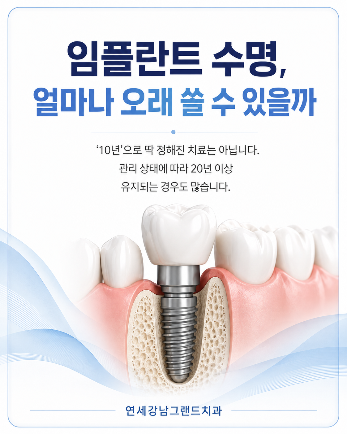 임플란트 수명, 얼마나 오래 쓸 수 있을까