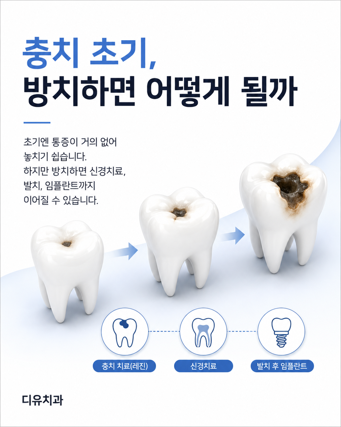충치 초기, 방치하면 어떻게 될까