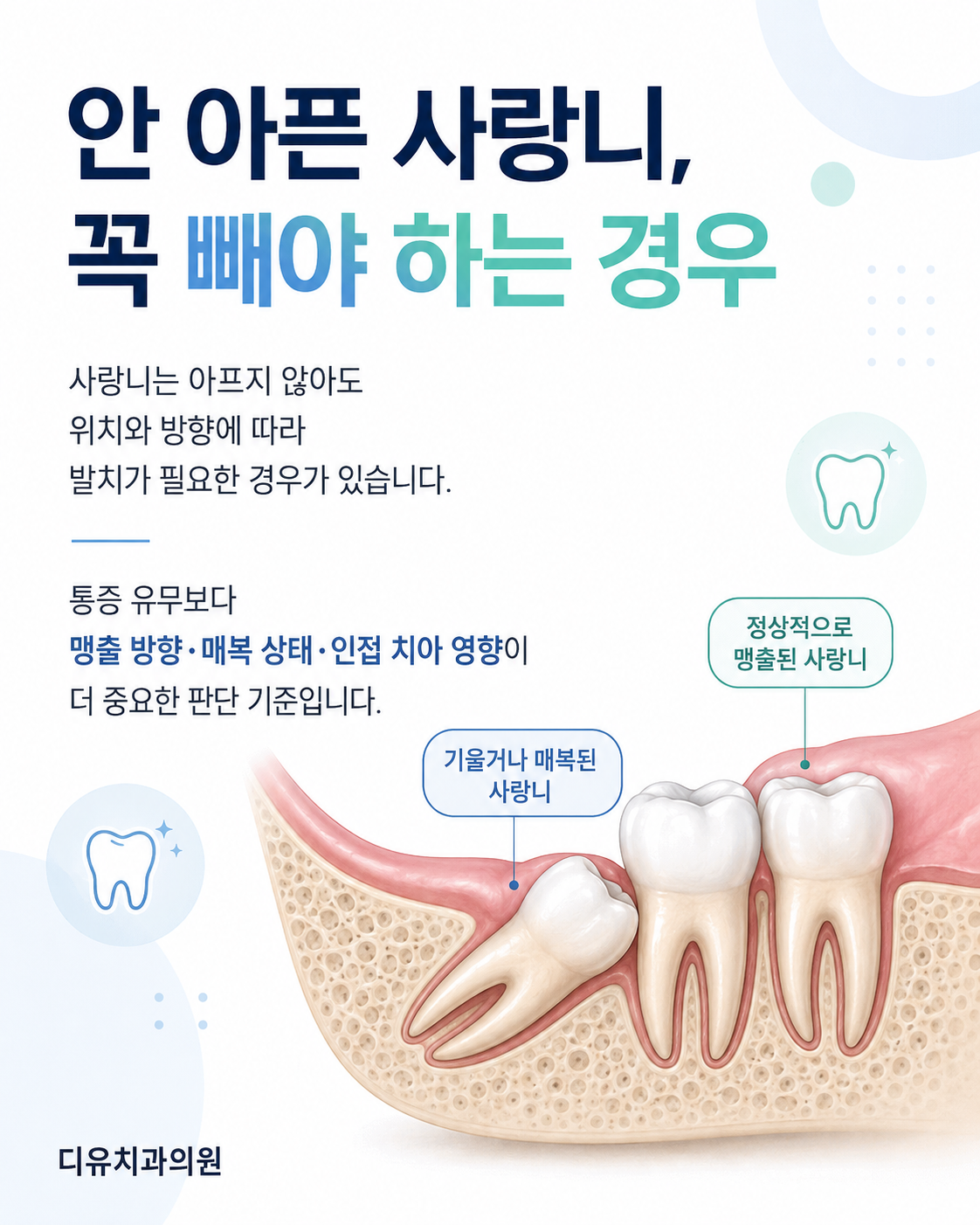안 아픈 사랑니, 꼭 빼야 하는 경우