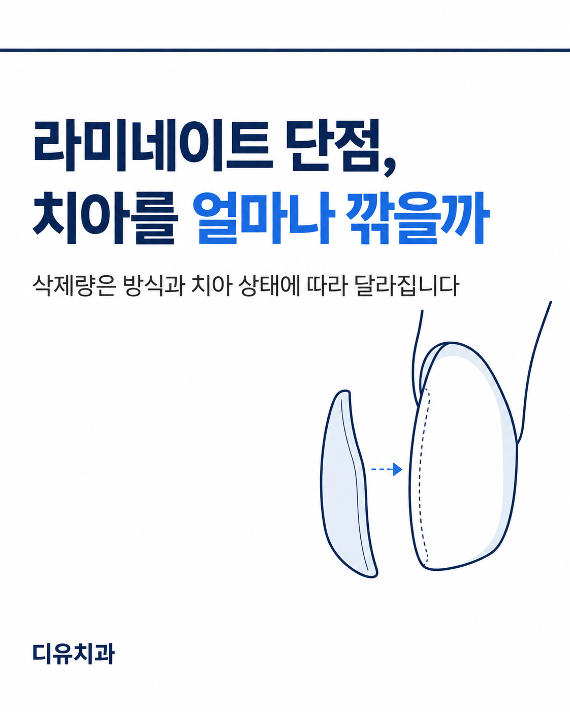 라미네이트 단점, 치아를 얼마나 깎을까