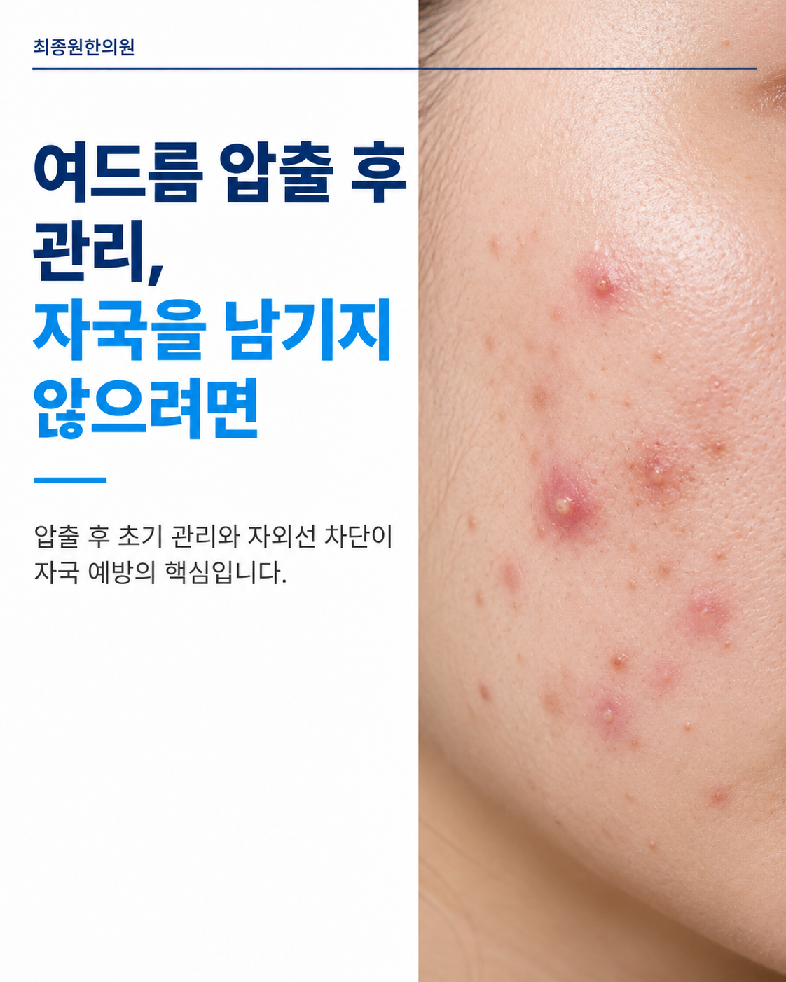 여드름 압출 후 관리, 자국을 남기지 않으려면