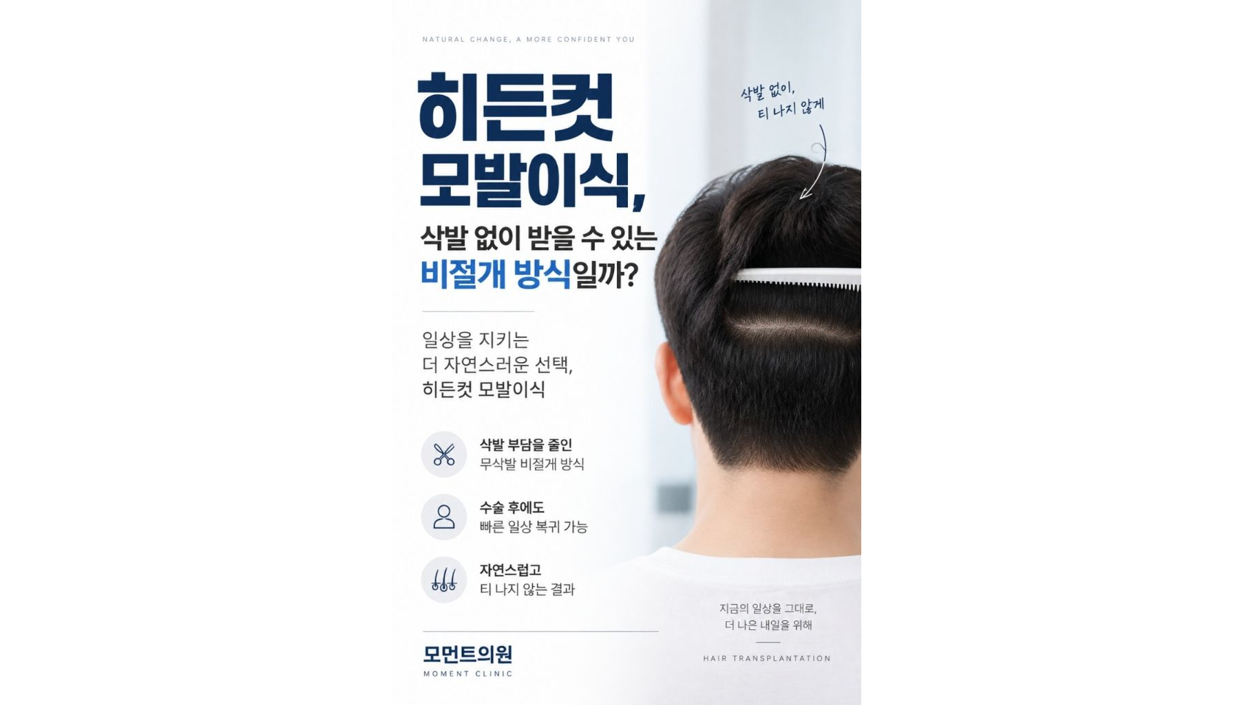히든컷 모발이식, 삭발 없이 받을 수 있는 비절개 방식일까?